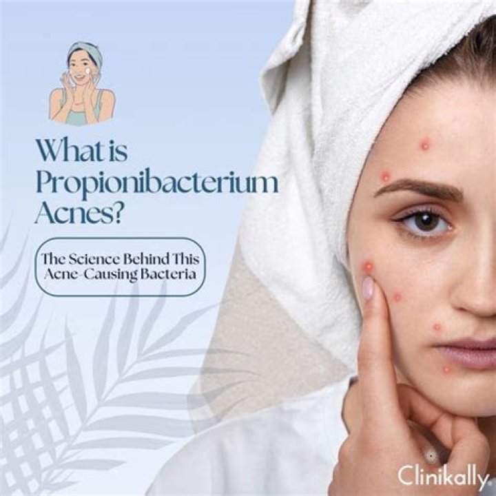 What kills Propionibacterium acnes?